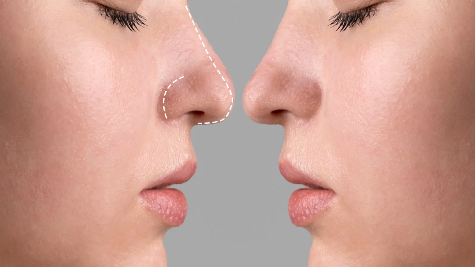 Rhinoplastik – moderne Planung von Form und Funktion