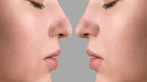 Rhinoplastik – moderne Planung von Form und Funktion